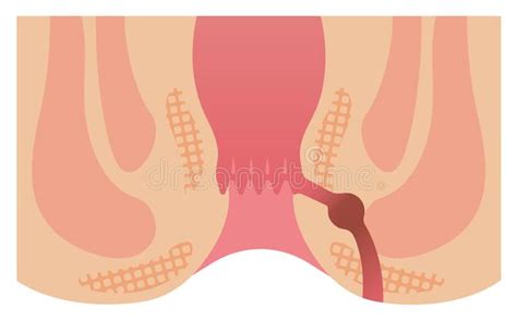 Proctologia Emorroidi Fistole Anali Ragade Anale Dott Bruno