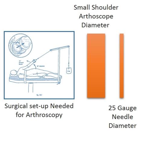 Shoulder Labrum Surgery Alternative For Faster Recovery