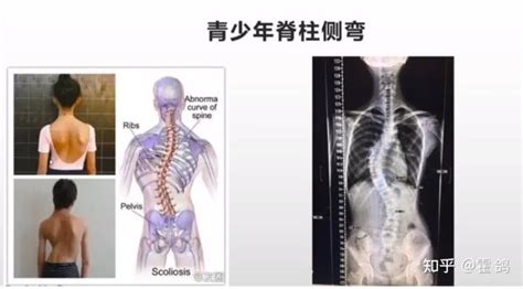 导致脊柱侧弯的原因及危害 知乎