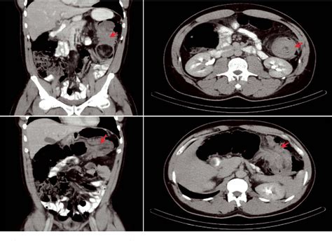 Figure 1 From A Case Of Colonic Intussusception And Obstruction Secondary To Giant Colonic