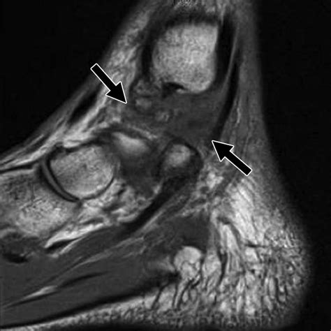 Mri Of Ankle And Lateral Hindfoot Impingement Syndromes Ajr