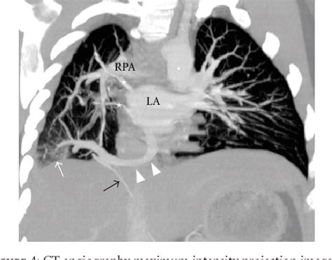 Figure 1 From Massive Hemoptysis In A Case Of Intralobar Pulmonary