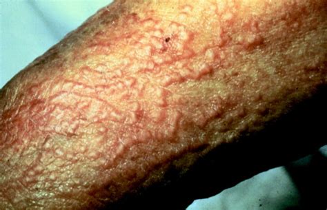 Cutaneous Manifestations Of Internal Malignancy Thiers 2009 Ca A Cancer Journal For