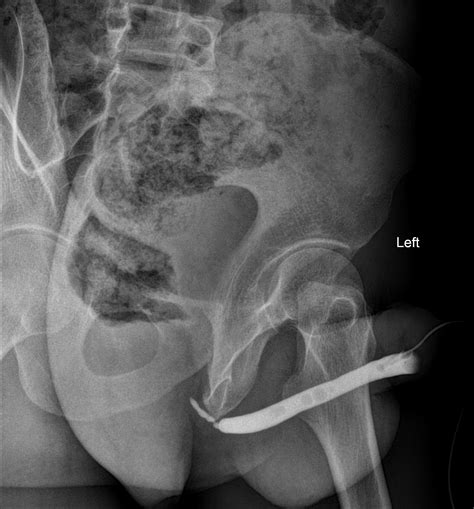 Urethral Stricture Image Radiopaedia Org