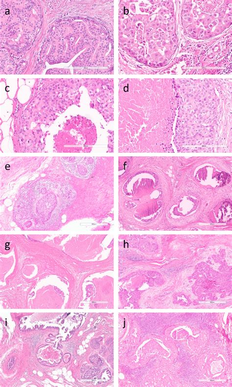 Photomicrographs From Histopathological Dcis Features Based On The