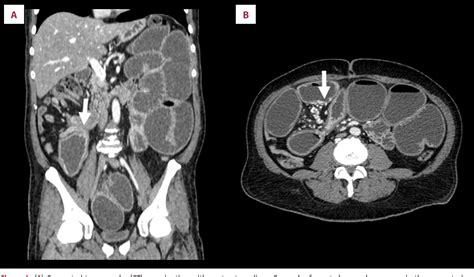 Figure 1 From Ileal Neuroendocrine Tumor In A Patient With Sclerosing Mesenteritis Which Came