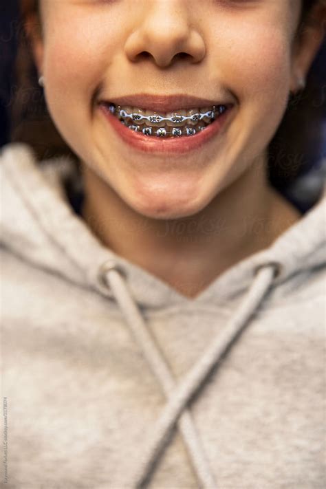 Girl Patient With Braces At Orthodontics Office By Stocksy