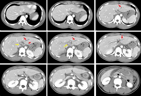 Grade I Liver Injury Radiology Cases