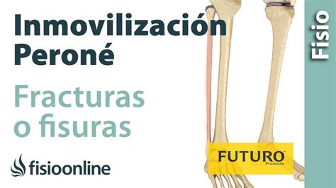 Inmovilización parcial de fracturas menores o fisuras del peroné