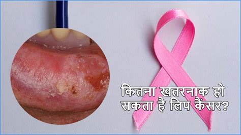 Lip Cancer Symptoms होंठ कैंसर के 7 संकेतों को न करें इग्नोर जानें