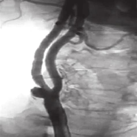 A Angiographic View Of A Right Sided Common Carotid Artery Cca