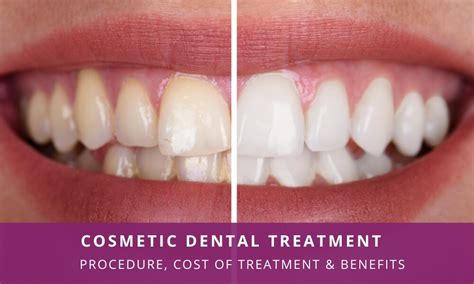 Super Easy Simple Ways The Pros Use To Promote Cost Of Tooth Veneers