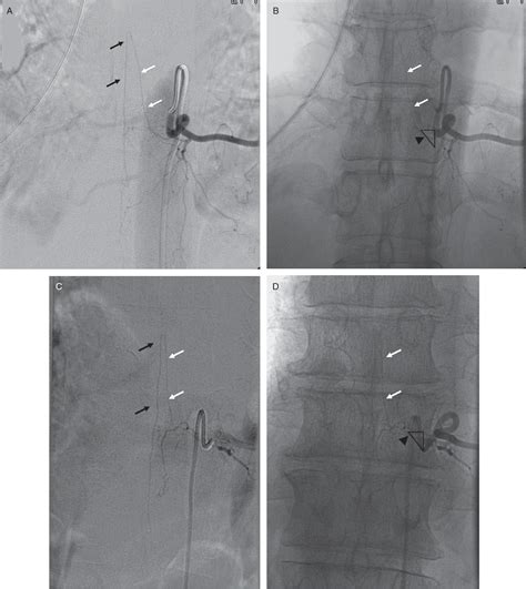 [PDF] Intraforaminal location of the great anterior radiculomedullary artery (artery of ...