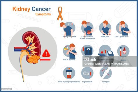 Symptoms Of Kidney Cancer Stock Illustration - Download Image Now - Illustration, Nephritic ...