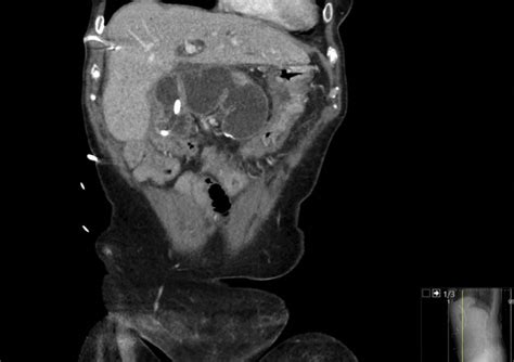 Ct Scan During Initial Diagnosis Demonstrating Obstruction Of Afferent