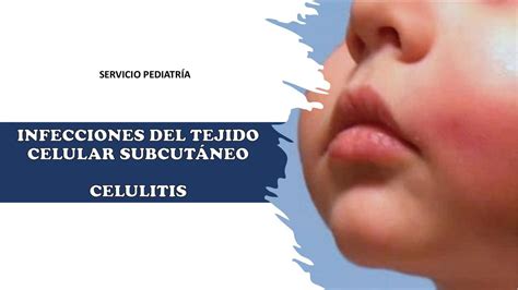 Celulitis Shirley Tustón uDocz