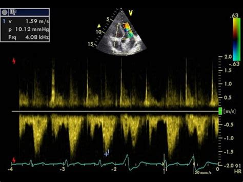 The Doppler Effect Applied Physics Cardiology Echocardiography