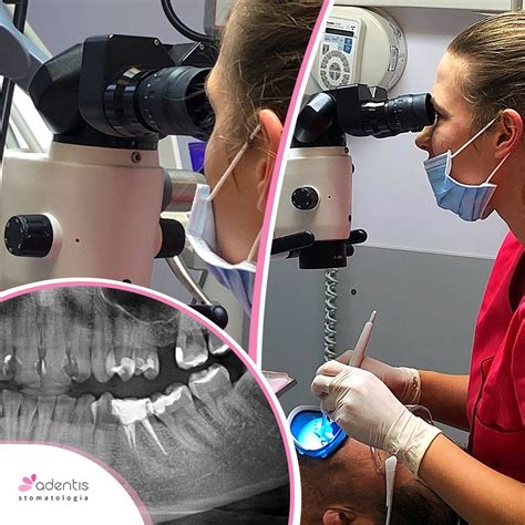 Leczenie Kana Owe Pod Mikroskopem Endodoncja Warszawa Ursyn W Adentis