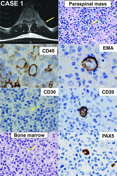 T Cell Histiocyte Rich Large B Cell Lymphoma In Pediatric Patients An Under Recognized Entity