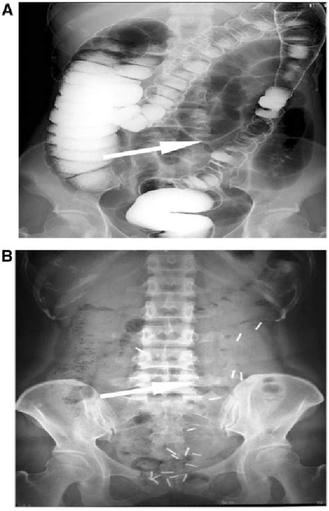 Figure 1 From Comparison Of Laparoscopic Selective Colectomy Based On