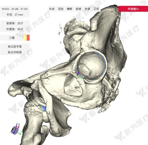 案例分享 人工智能精准规划髋关节置换术 知乎