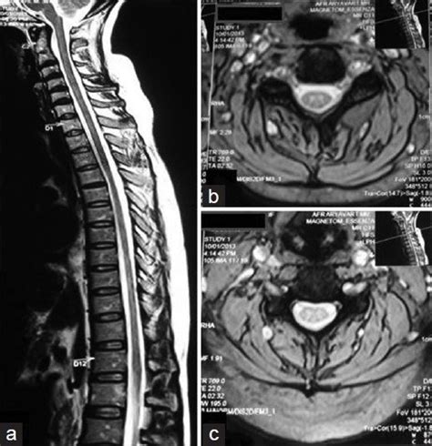 A Sagittal T2 Weighted Magnetic Resonance Imaging Image Shows Diffuse