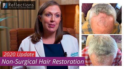 Hair Loss Treatments In 2022 [new Science And Techniques] Youtube