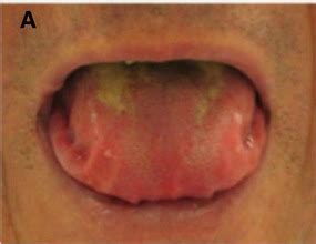 [Figure, Systemic AL Amyloidosis, Pathology, Macroglossia ...