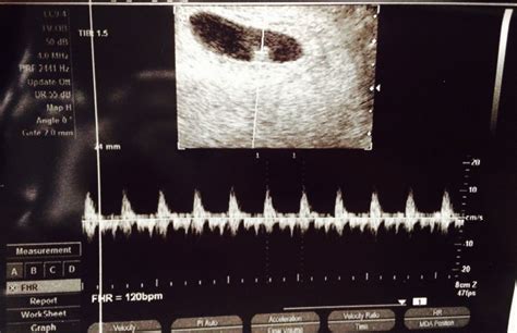 Baby only measuring 4weeks, 1 day with a heartbeat. I should be 6 weeks ...