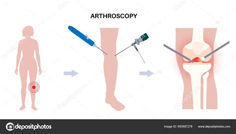 Arthroscopy Medical Procedure Knee Joint Minimally Invasive Surgery