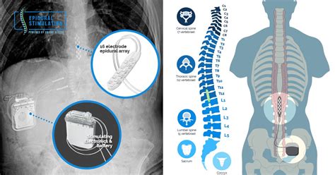 Epidural Stimulation Surgery Treatment - Epidural Stimulation Now