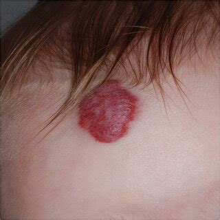 Infantile Hemangioma In A Month Old Girl With A Growing Soft Mass Of