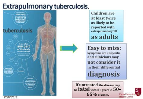 Extrapulmonary tuberculosis,What to know?