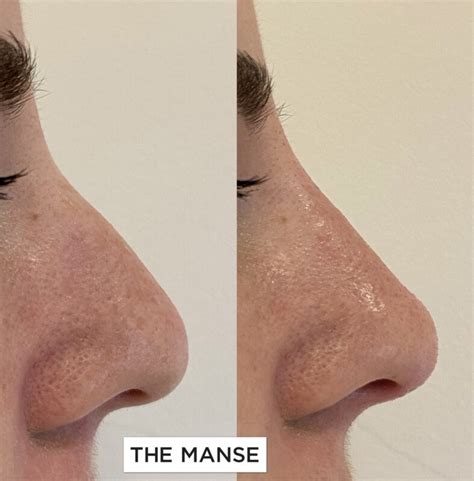 Nose Filler Non Surgical Rhinoplasty At Our Expert Sydney Clinic