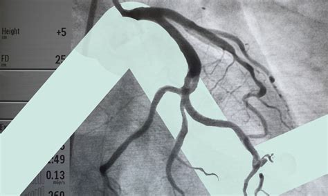 myocardial infarction   obstructed coronary arteries