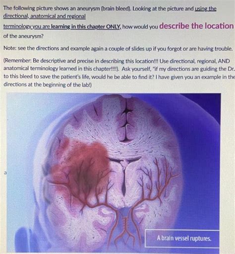 Solved The Following Picture Shows An Aneurysm Brain Chegg