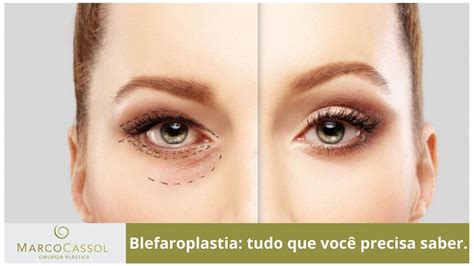 Blefaroplastia Descubra Tudo Sobre Este Procedimento