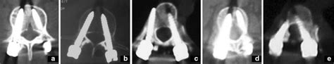 Gertzbein’s Classification Of Screw Misplacement In Axial Ct Images A Download Scientific