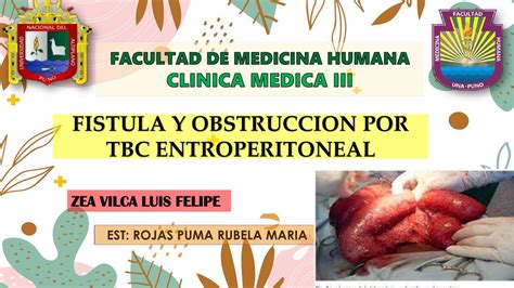 Fistulas y obstrucción por TBC en enteroperitoneal ROJAS PUMA RUBELA