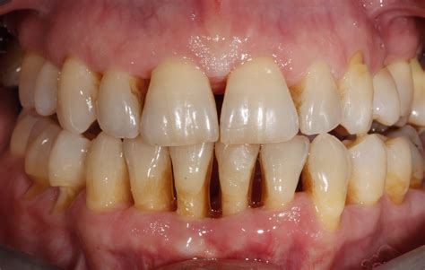 Caso De Xito Enfermedad Periodontal Tratada Con Ortodoncia Invisible