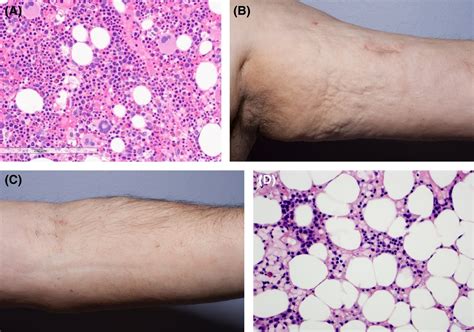 All You Must Know About Aplastic Anemia Medsurge India