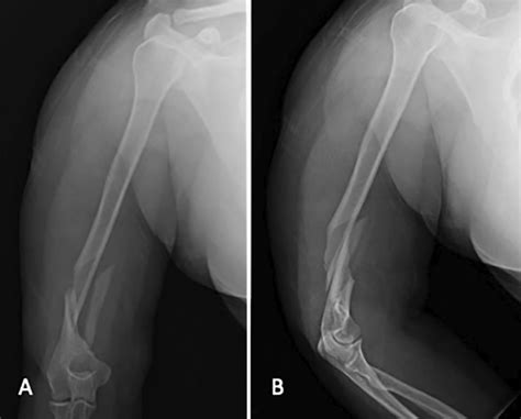 Anteroposterior (A) and lateral (B) view of humerus distal spiral ...