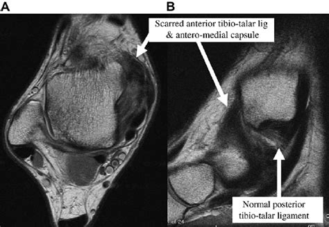 Patient With Anteromedial Impingement Symptoms A Axial And B