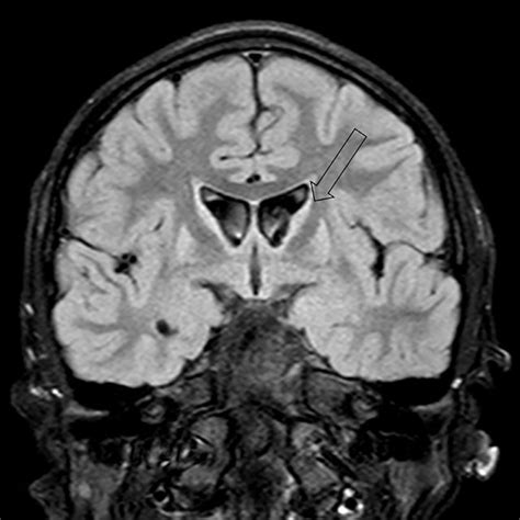 (PDF) MRI findings in juvenile Huntington's disease