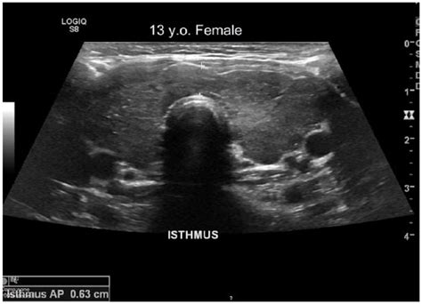 Normal Thyroid Ultrasound