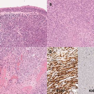 A Low Power View Of A Highly Cellular Spindle Cell Lesion