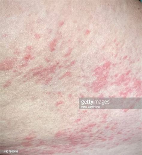 284 Nettle Rash Photos Stock Photos, High-Res Pictures, and Images - Getty Images