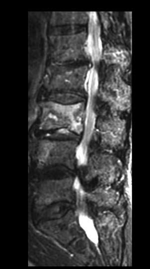 A Short Tau Inversion Recovery Stir Sequence Performed At