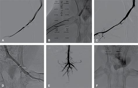 Procedure Digital Subtraction Angiography Images Demonstrating The