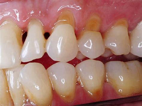 Wat Is Tandcariës De Oorzaken Van De Ziekte De Symptomen En Methoden